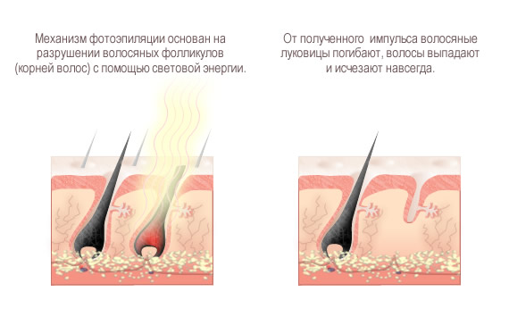  The principle of photoepilation